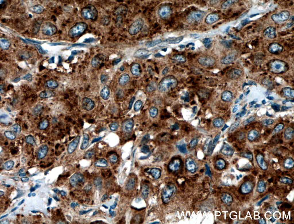 IHC staining of human cervical cancer using 12805-1-AP (same clone as 12805-1-PBS)