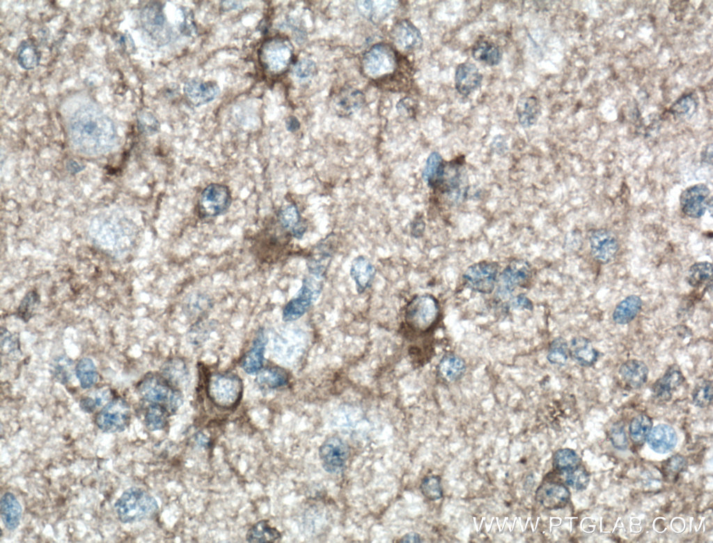 IHC staining of human gliomas using 11769-1-AP