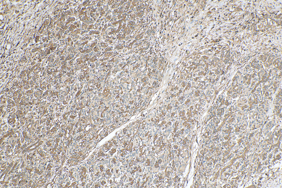 IHC staining of human pancreas cancer using 10769-1-AP