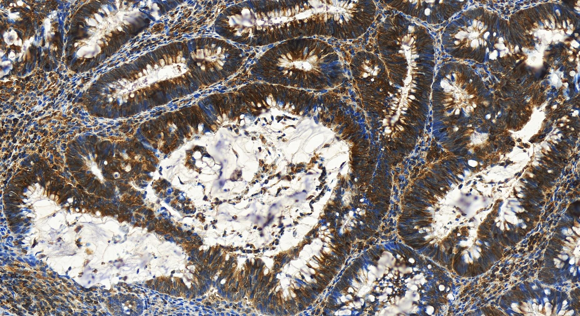 IHC staining of human colon  cancer using 82844-2-RR
