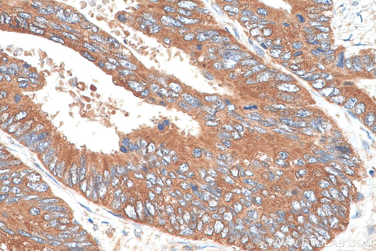 IHC staining of human colon cancer using 10729-1-AP