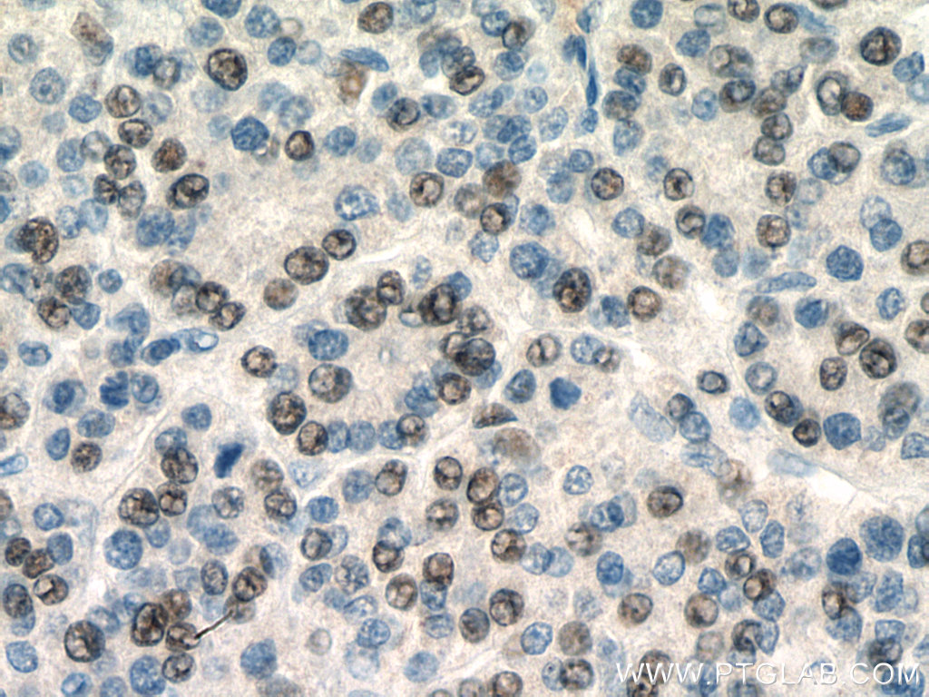 IHC staining of human liver cancer using 67792-1-Ig