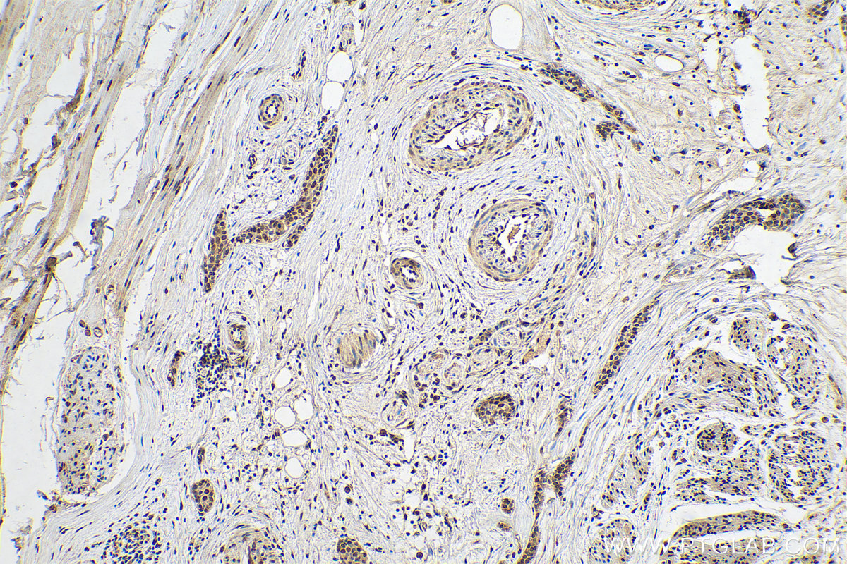 IHC staining of human urothelial carcinoma using 67248-1-Ig