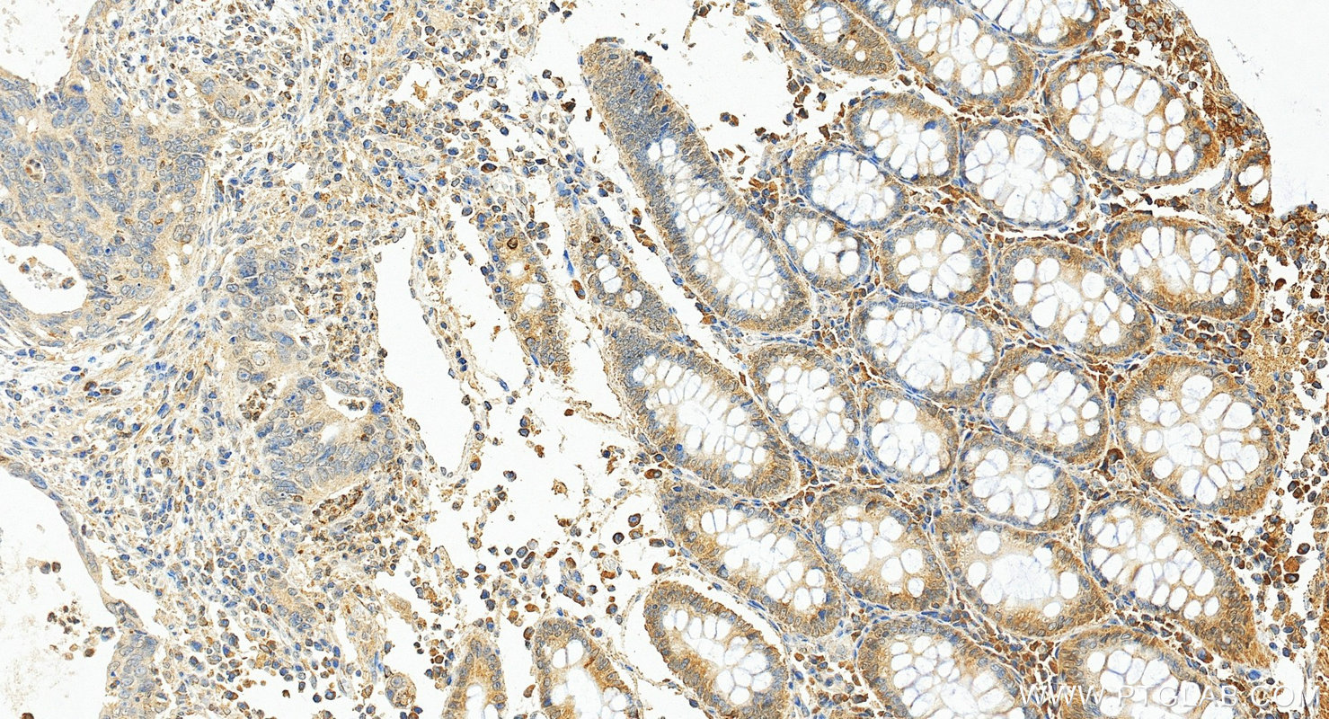 IHC staining of human colon cancer using 68287-1-Ig (same clone as 68287-1-PBS)