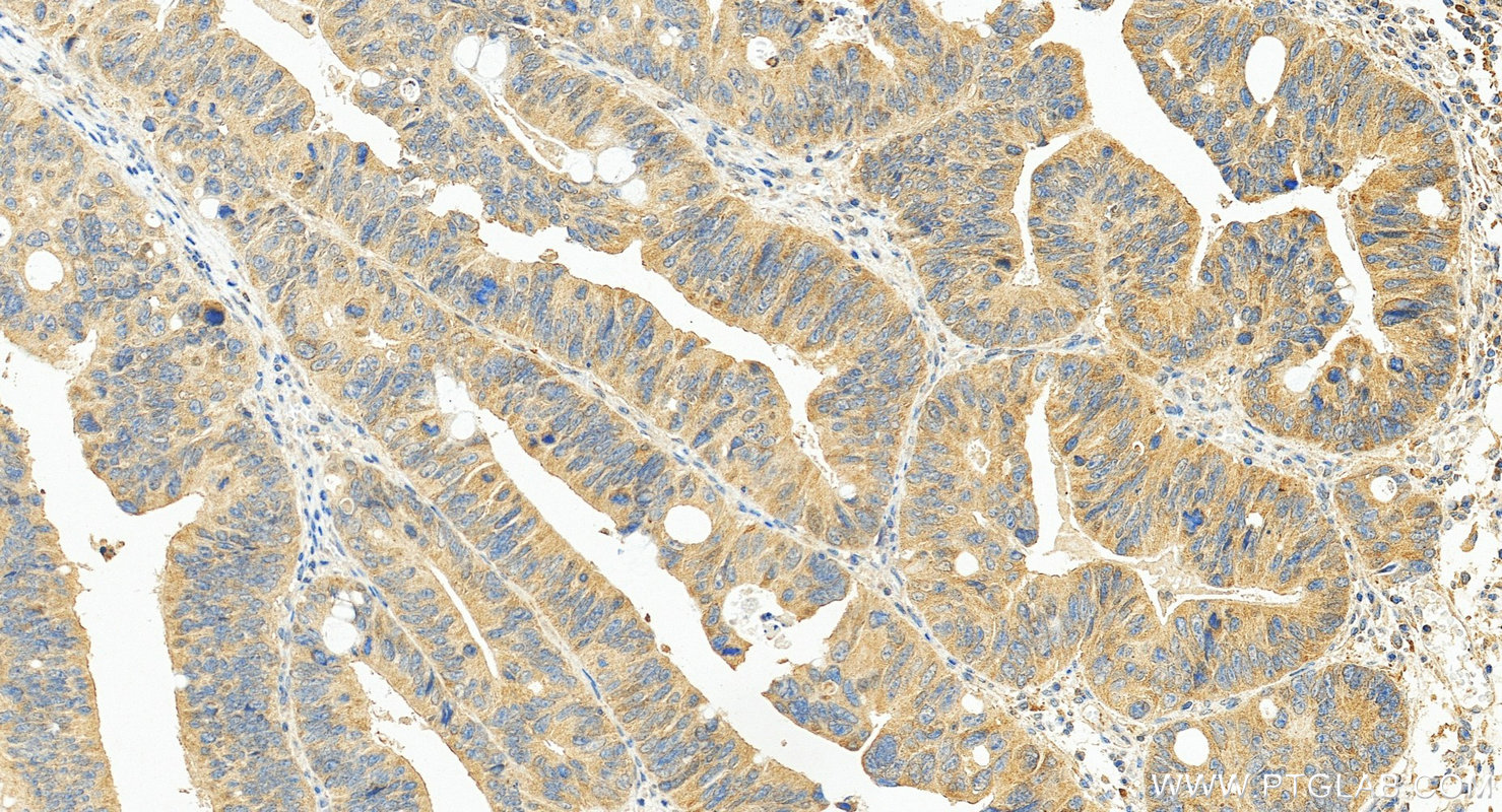 IHC staining of human colon cancer using 68287-1-Ig (same clone as 68287-1-PBS)