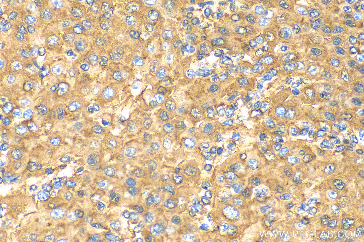 IHC staining of human liver cancer using 16382-1-AP