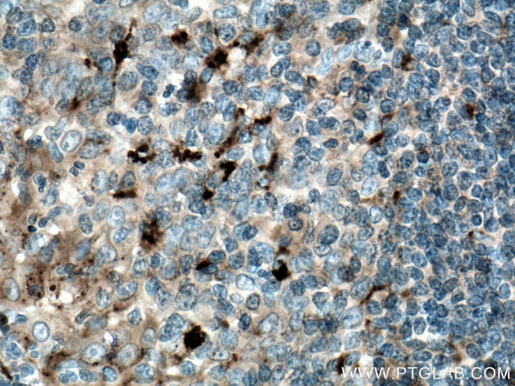 IHC staining of human tonsillitis using 66078-1-Ig