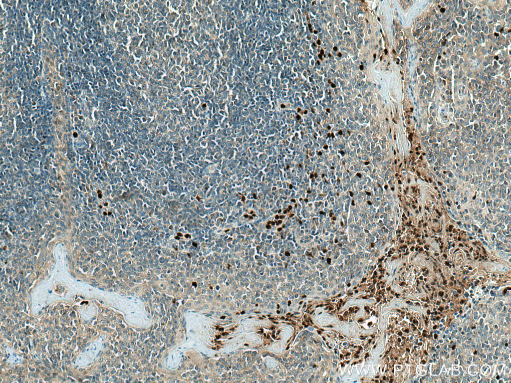 IHC staining of human tonsillitis using 21719-1-AP