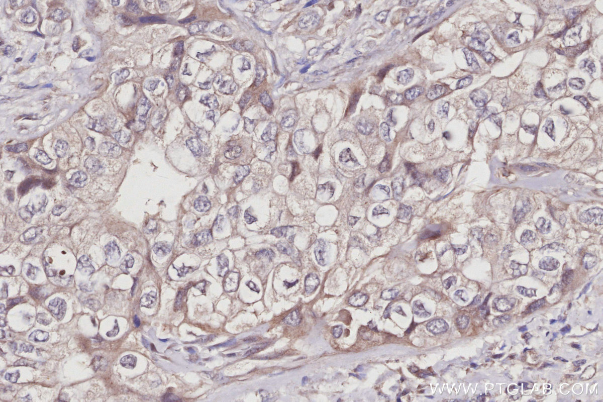 IHC staining of human pancreas cancer using 10167-1-AP IHC staining of human pancreas cancer using 10167-1-AP