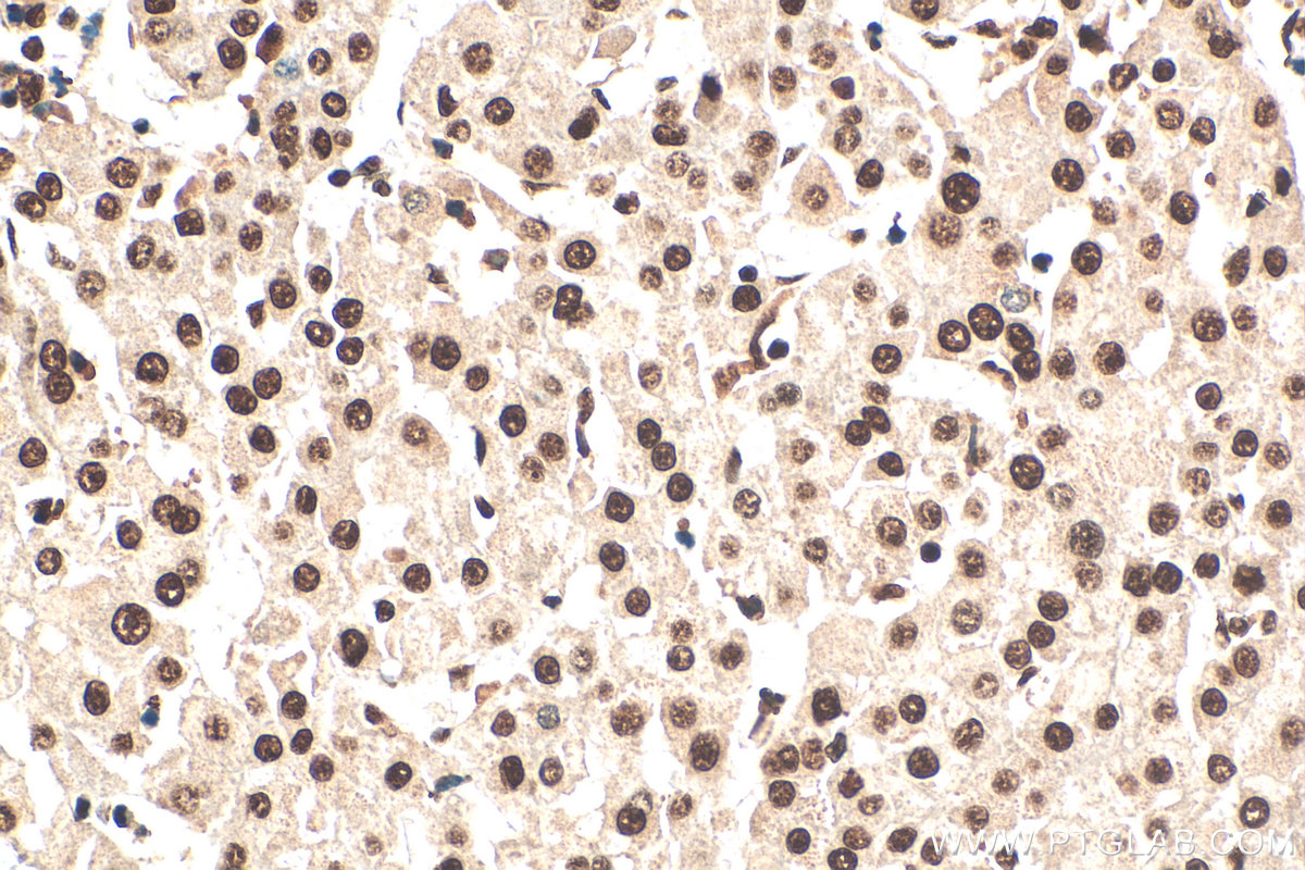 IHC staining of human liver cancer using 55201-1-AP IHC staining of human liver cancer using 55201-1-AP