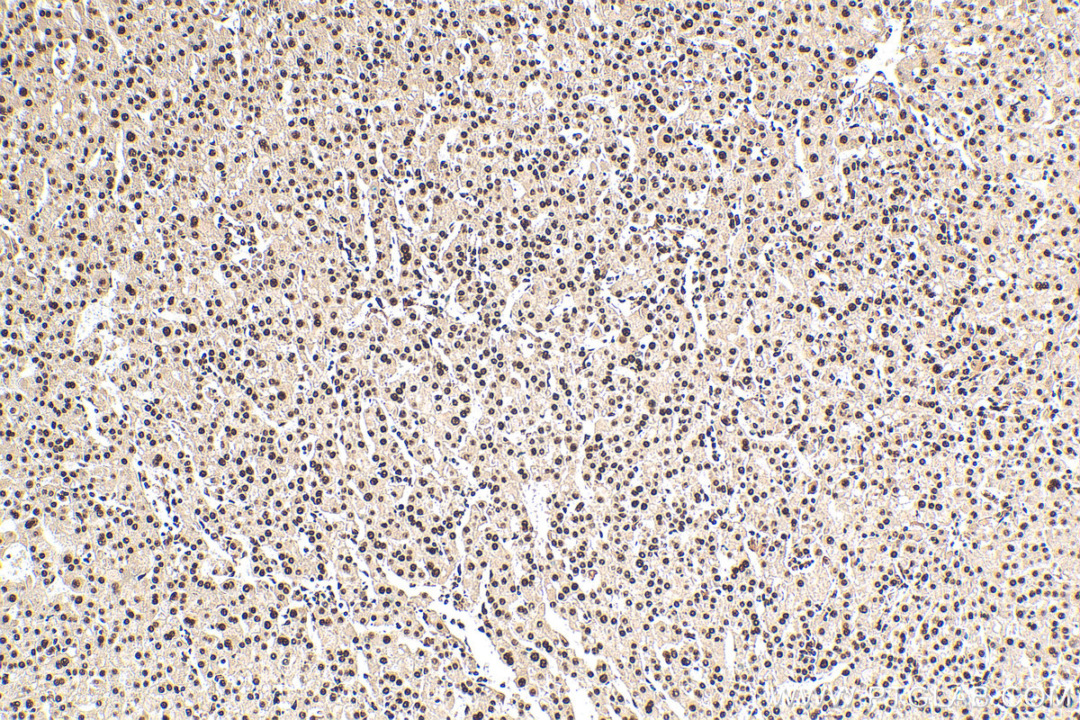 IHC staining of human liver cancer using 55201-1-AP IHC staining of human liver cancer using 55201-1-AP