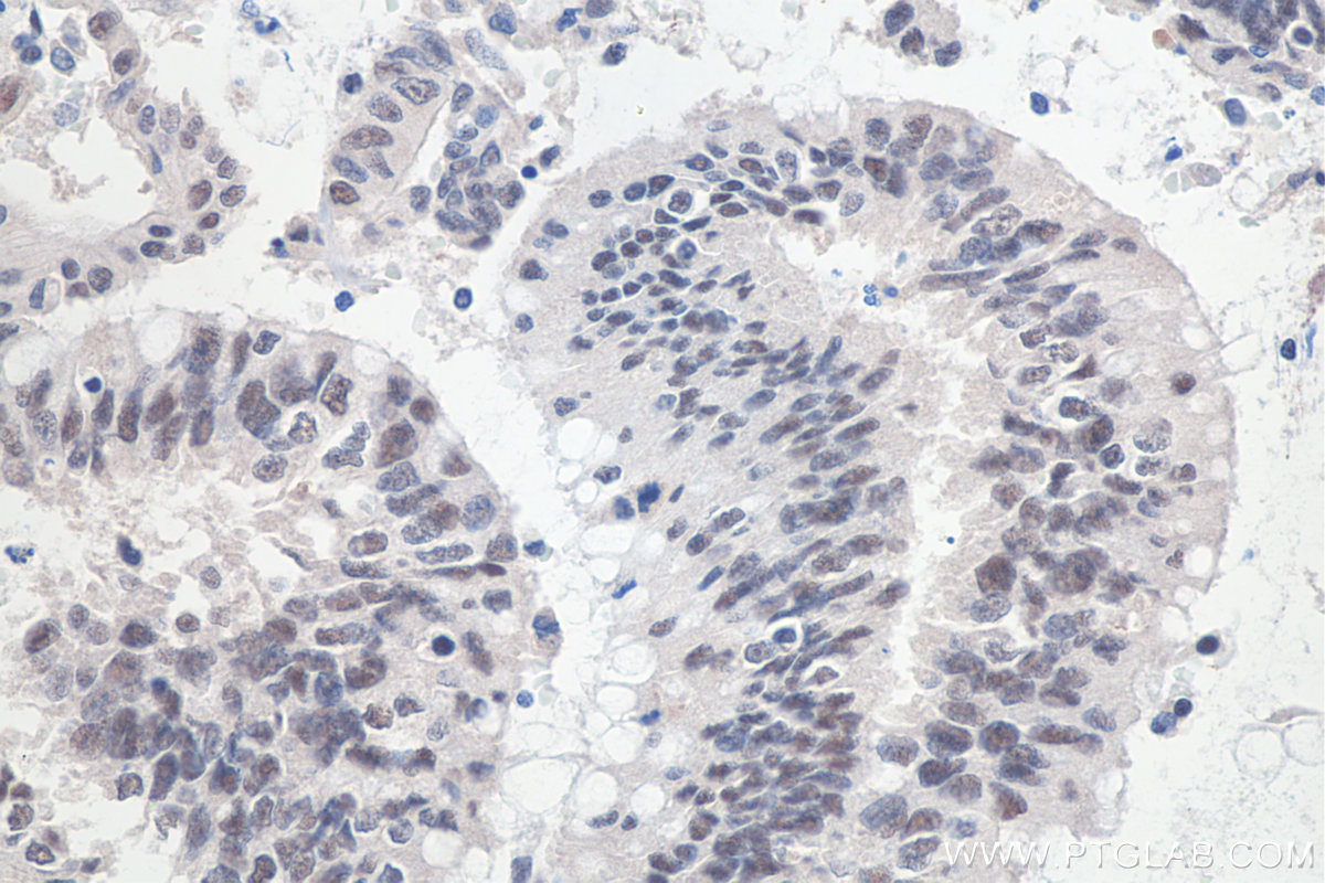 IHC staining of human colon cancer using 11231-1-AP IHC staining of human colon cancer using 11231-1-AP