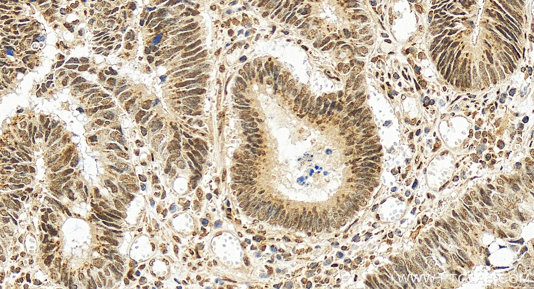 IHC staining of human colon cancer using 83772-6-RR (same clone as 83772-6-PBS)