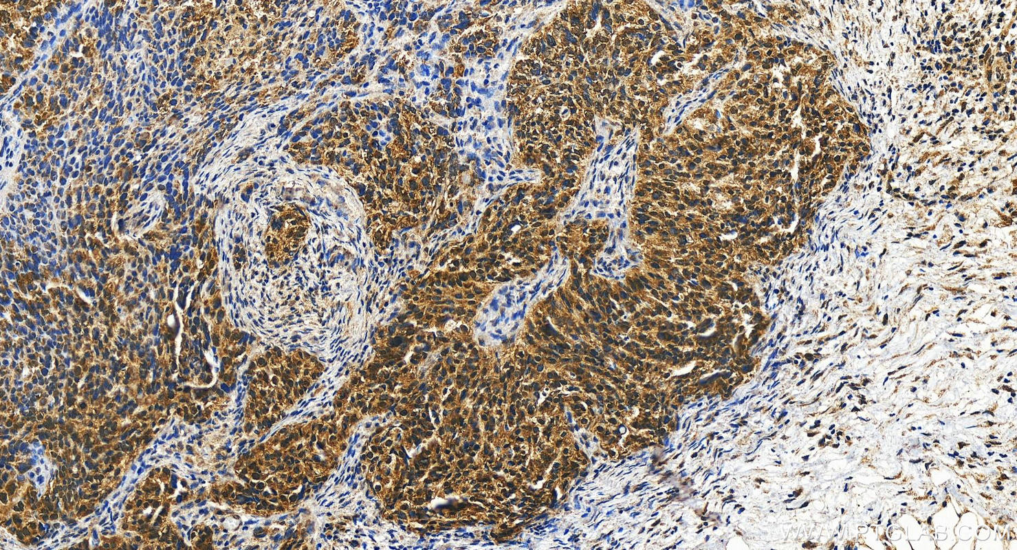 IHC staining of human ovary cancer using 13837-1-AP