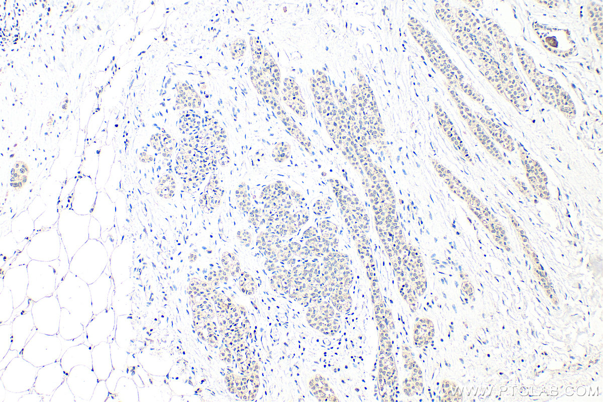 IHC staining of human breast cancer using 11635-1-AP
