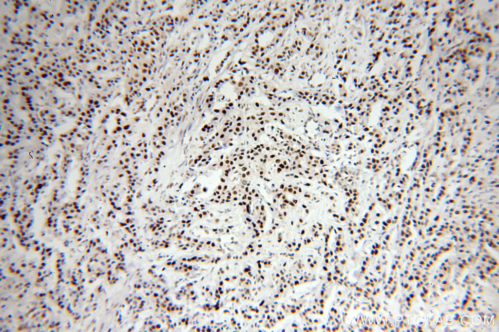 IHC staining of human breast cancer using 15858-1-AP