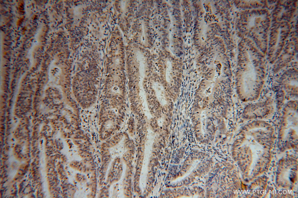 IHC staining of human endometrial cancer using 15596-1-AP