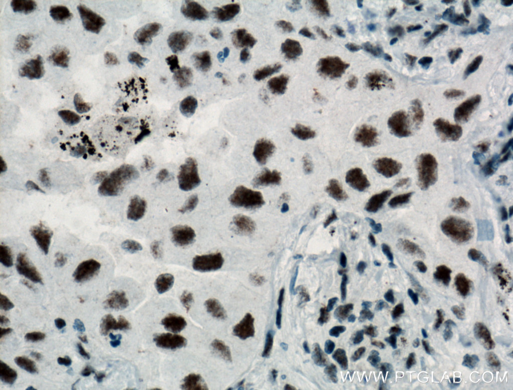 IHC staining of human lung cancer using 12070-1-AP