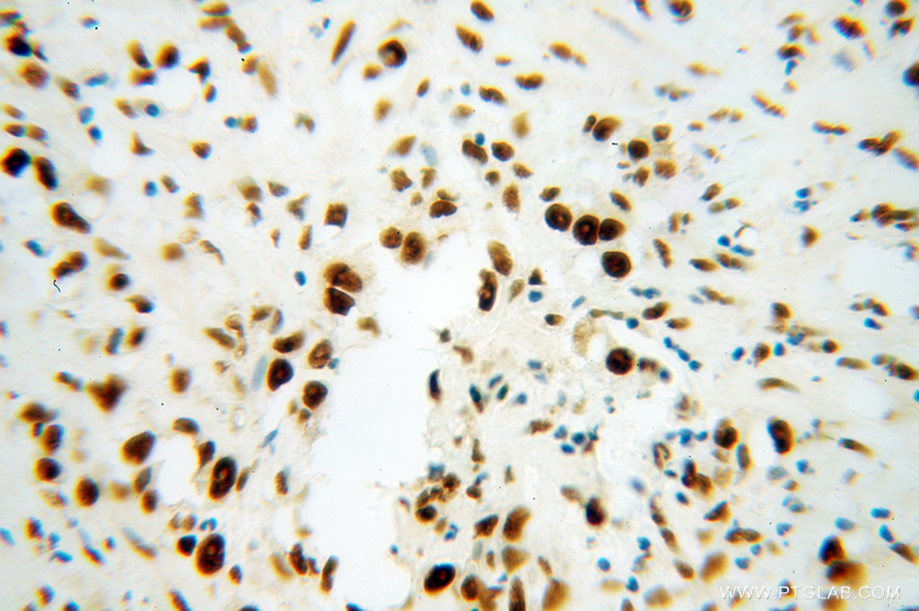 IHC staining of human gliomas using 14577-1-AP
