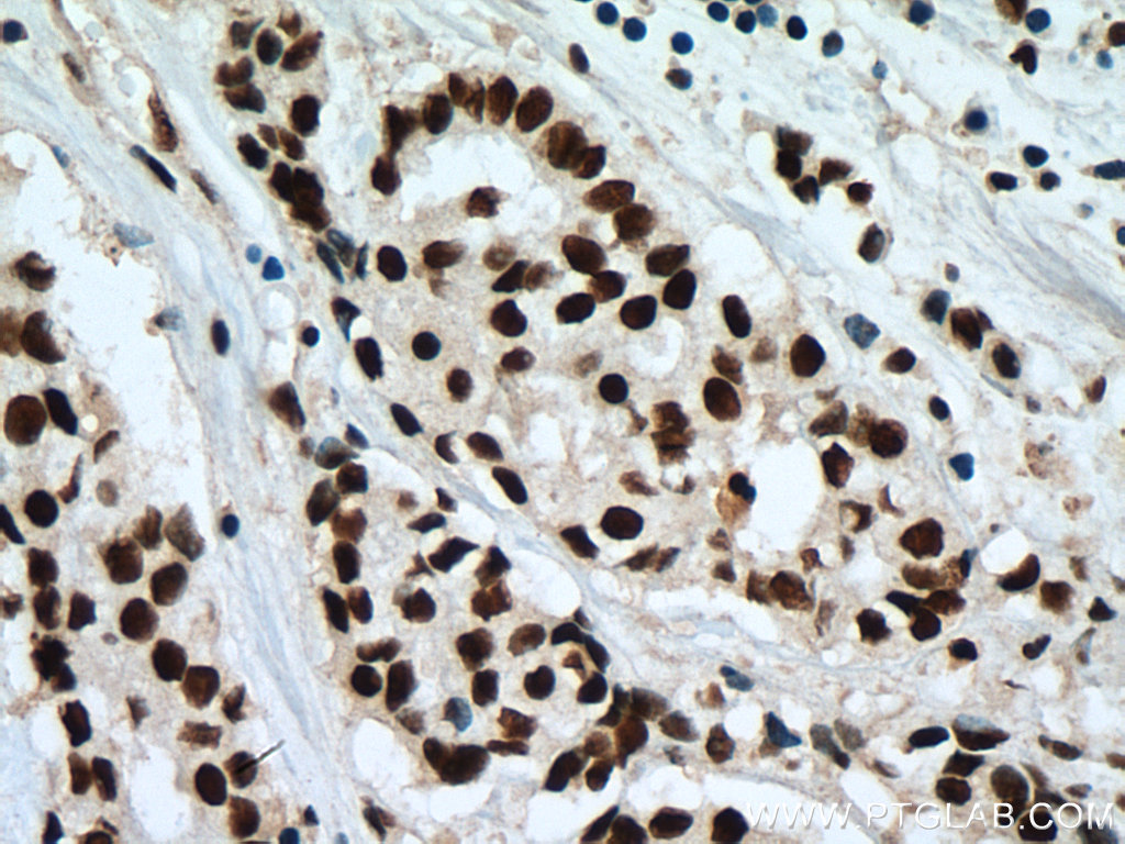 IHC staining of human breast cancer using 67469-1-Ig (same clone as 67469-1-PBS)