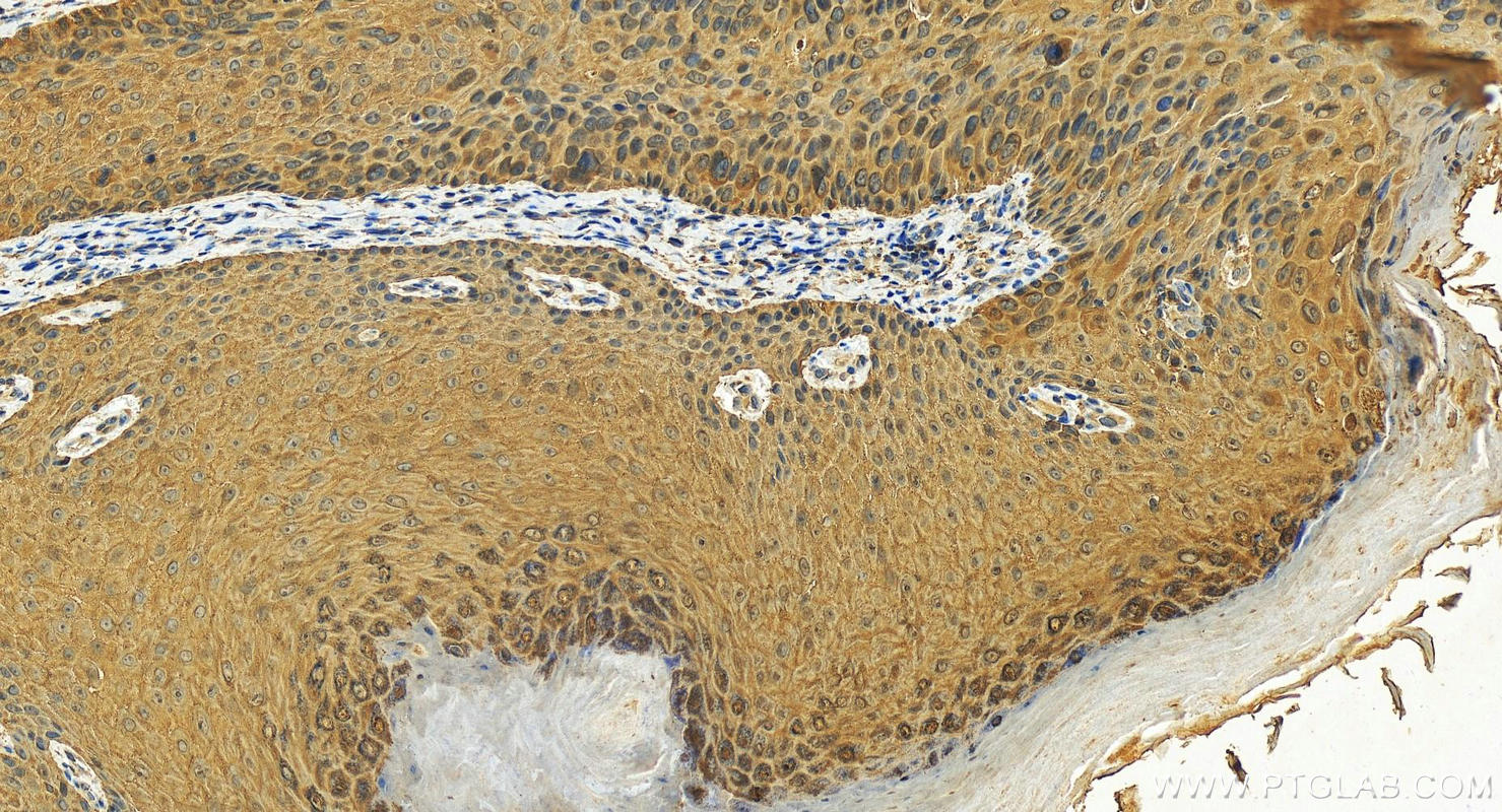 IHC staining of human bowen disease using 10622-1-AP