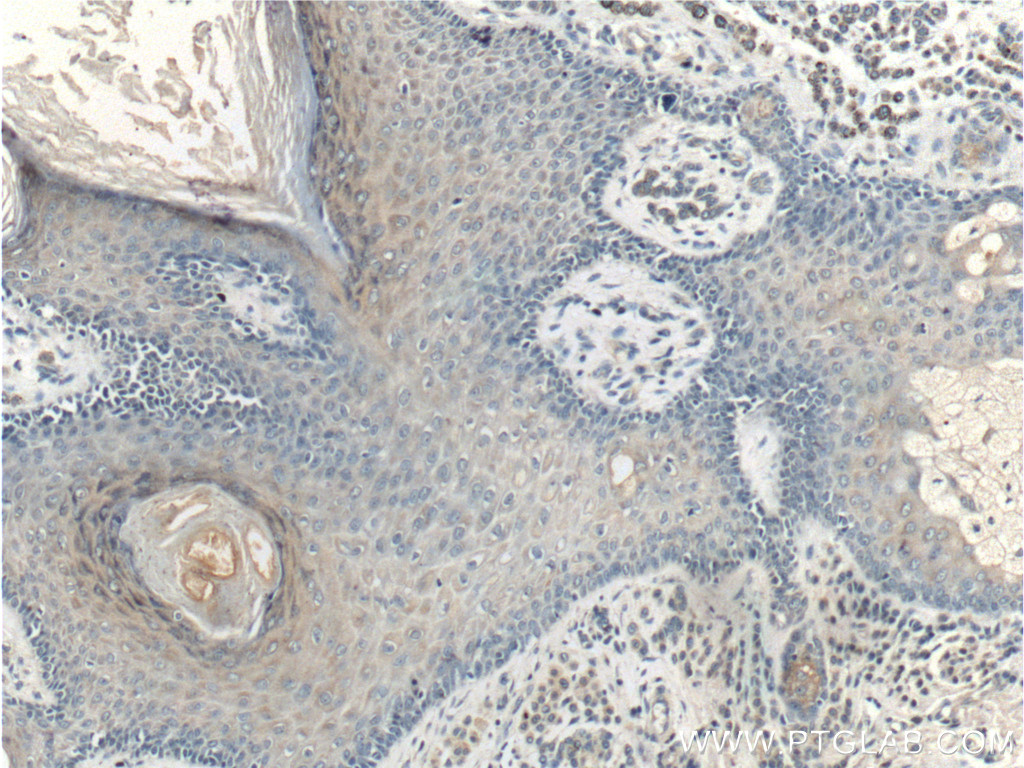 IHC staining of human malignant melanoma using 66328-1-Ig