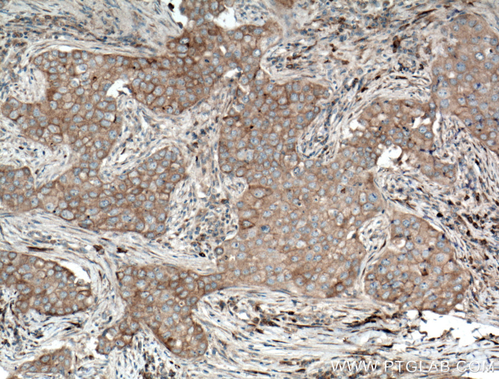 IHC staining of human breast cancer using 15328-1-AP (same clone as 15328-1-PBS)