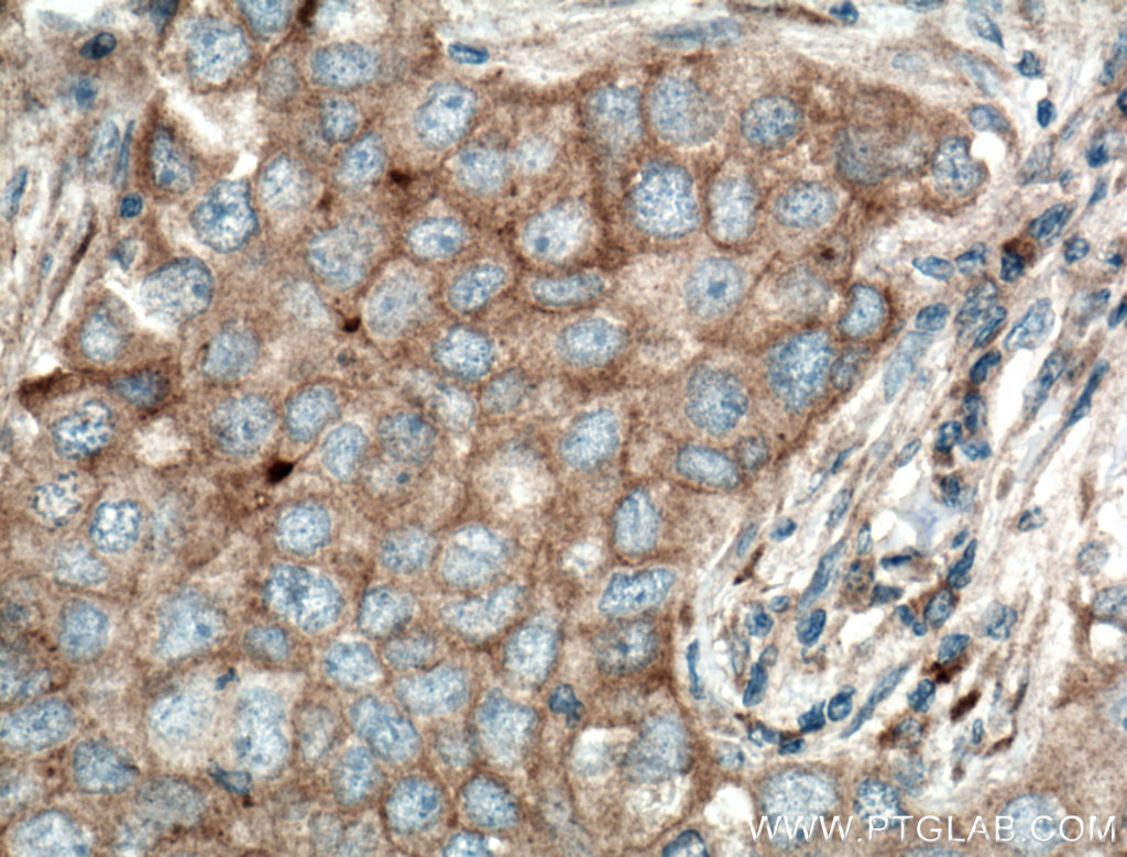 IHC staining of human breast cancer using 15328-1-AP