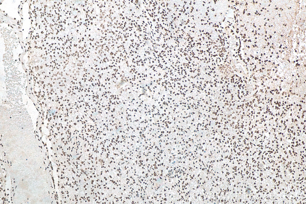 IHC staining of human gliomas using 12929-2-AP