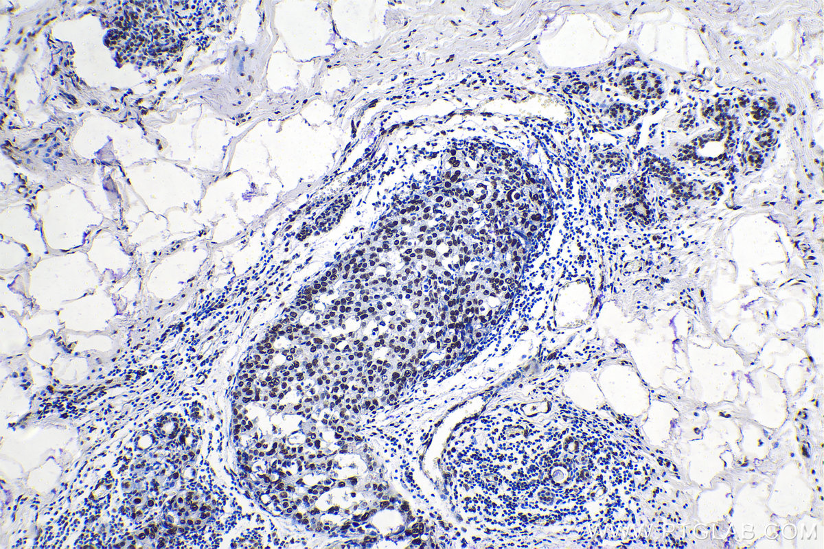 IHC staining of human breast cancer using 26751-1-AP