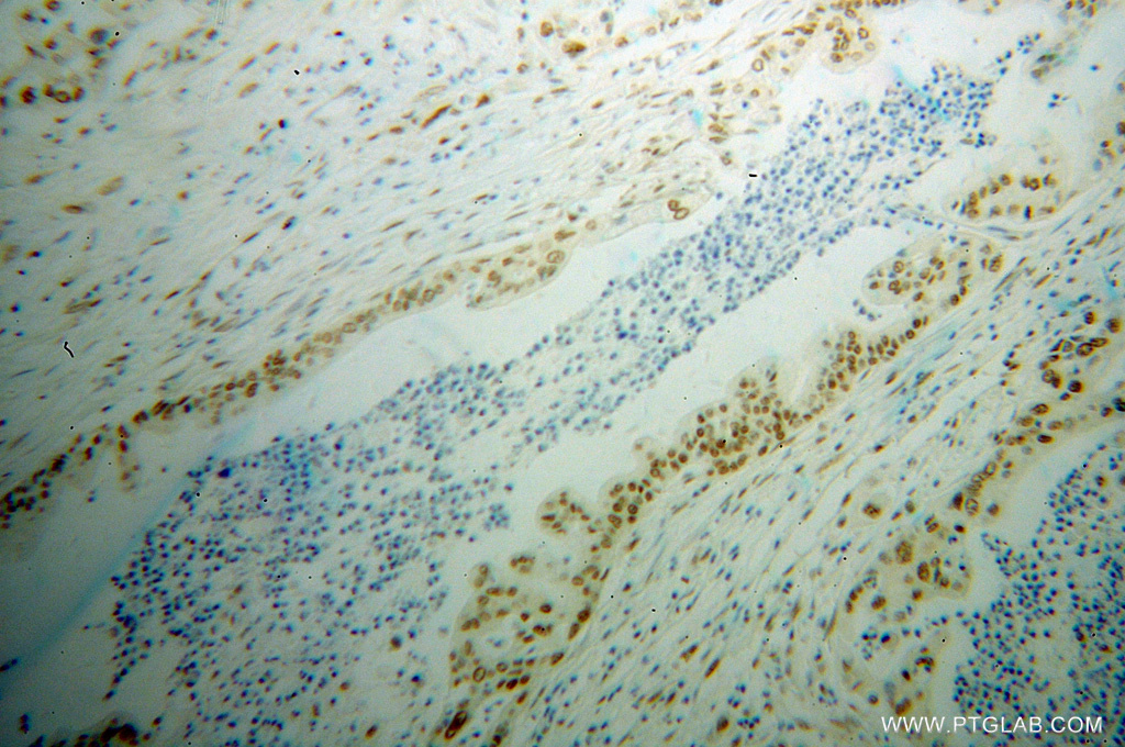 IHC staining of human pancreas cancer using 13441-1-AP