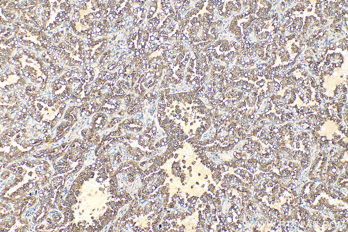 IHC staining of human lung cancer using 13664-1-AP