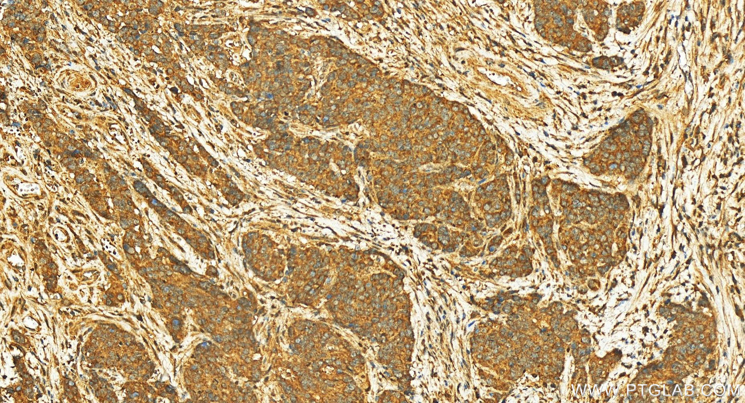 IHC staining of human stomach cancer using 12407-1-AP