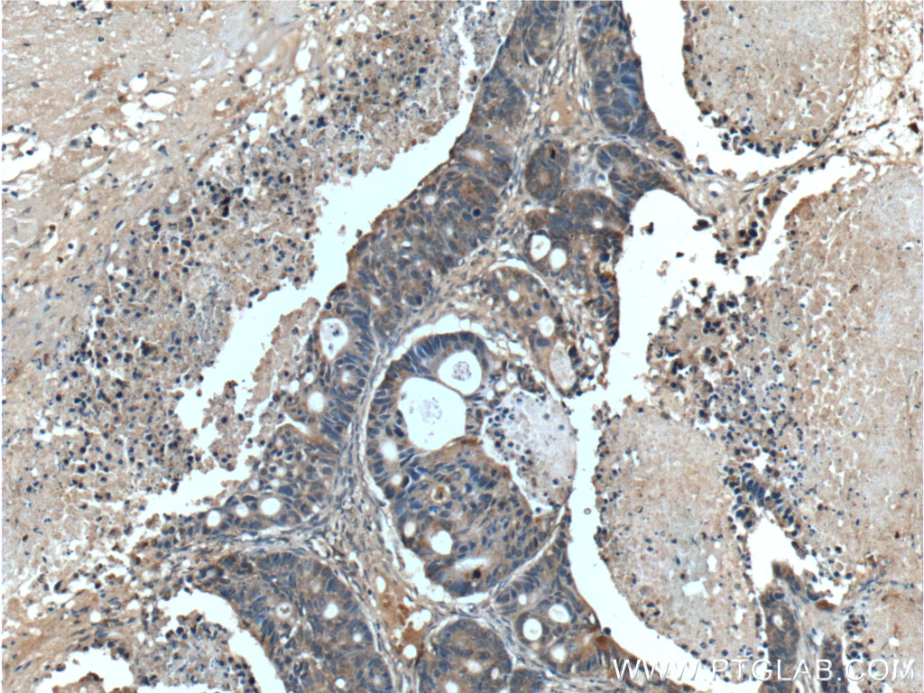 IHC staining of human pancreas cancer using 11185-1-AP