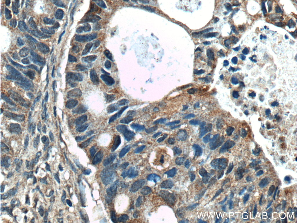 IHC staining of human pancreas cancer using 11185-1-AP