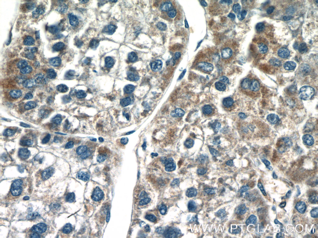 IHC staining of human liver cancer using 22100-1-AP