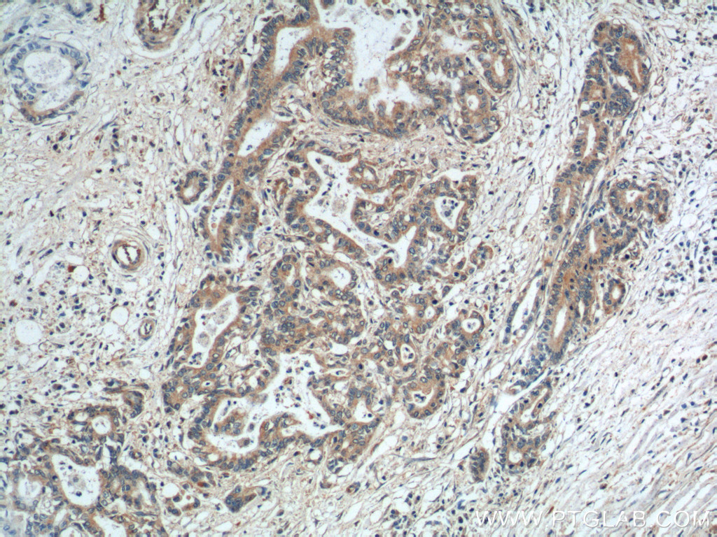 IHC staining of human pancreas cancer using 14184-1-AP