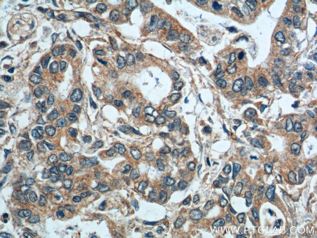 IHC staining of human pancreas cancer using 14184-1-AP