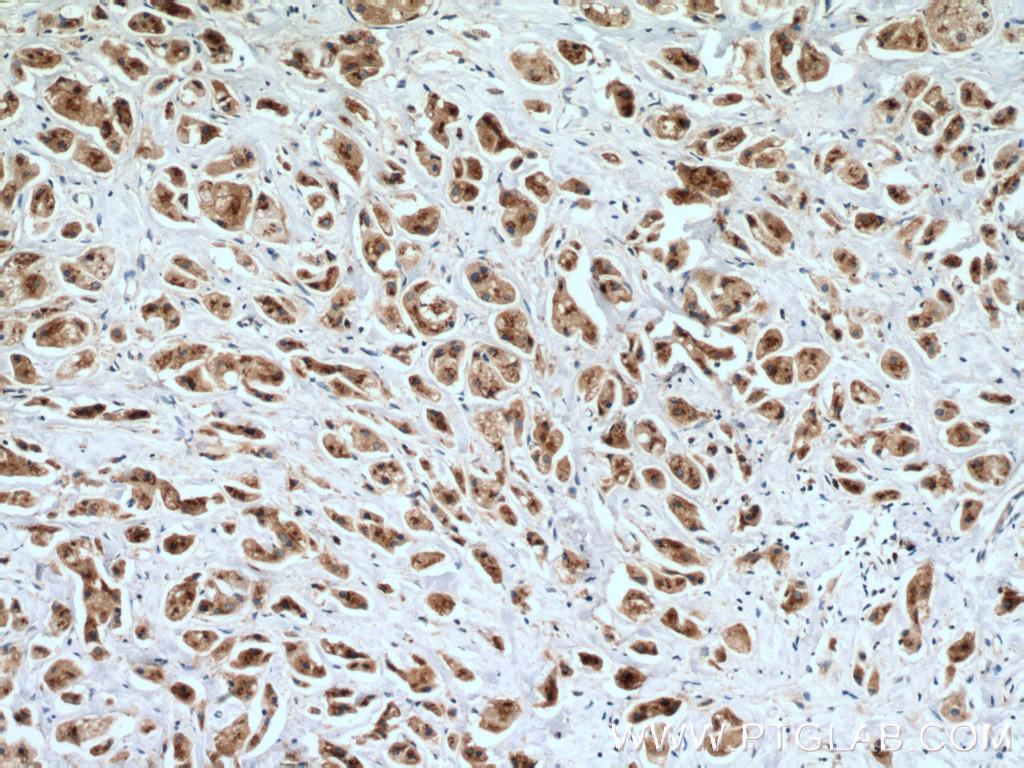 IHC staining of human breast cancer using 27147-1-AP