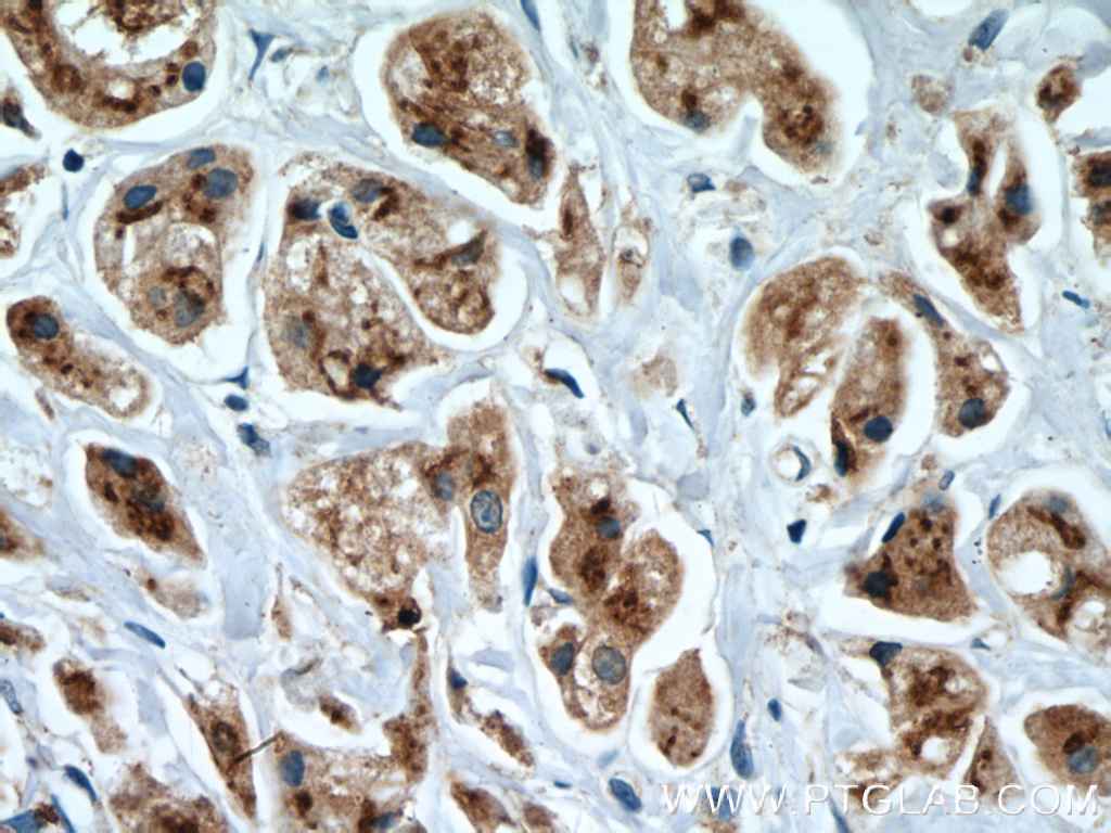 IHC staining of human breast cancer using 27147-1-AP