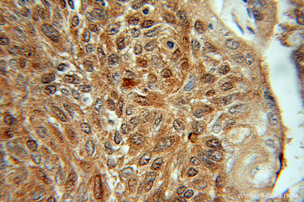 IHC staining of human lung cancer using 11019-2-AP (same clone as 11019-2-PBS)