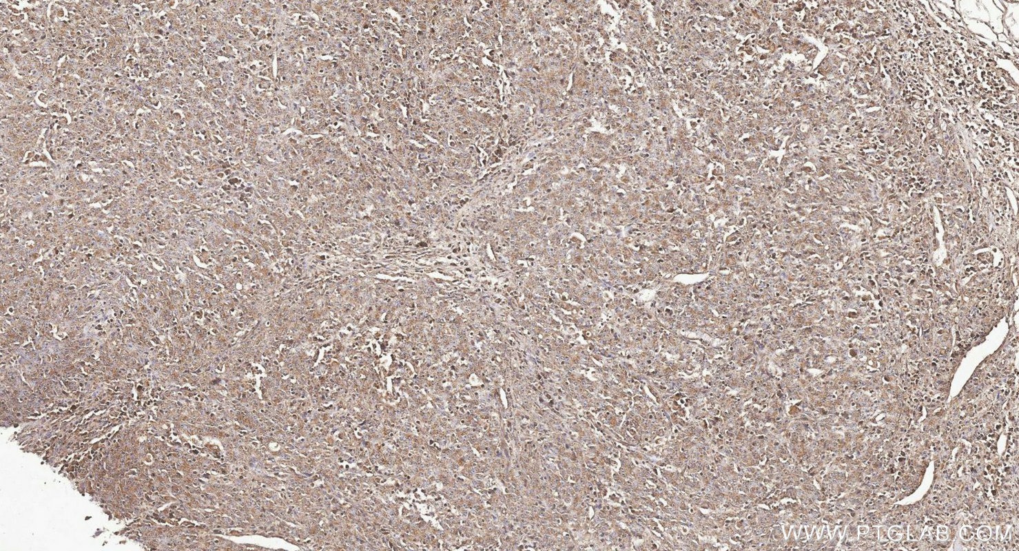 IHC staining of human lymphoma using 22198-1-AP IHC staining of human lymphoma using 22198-1-AP