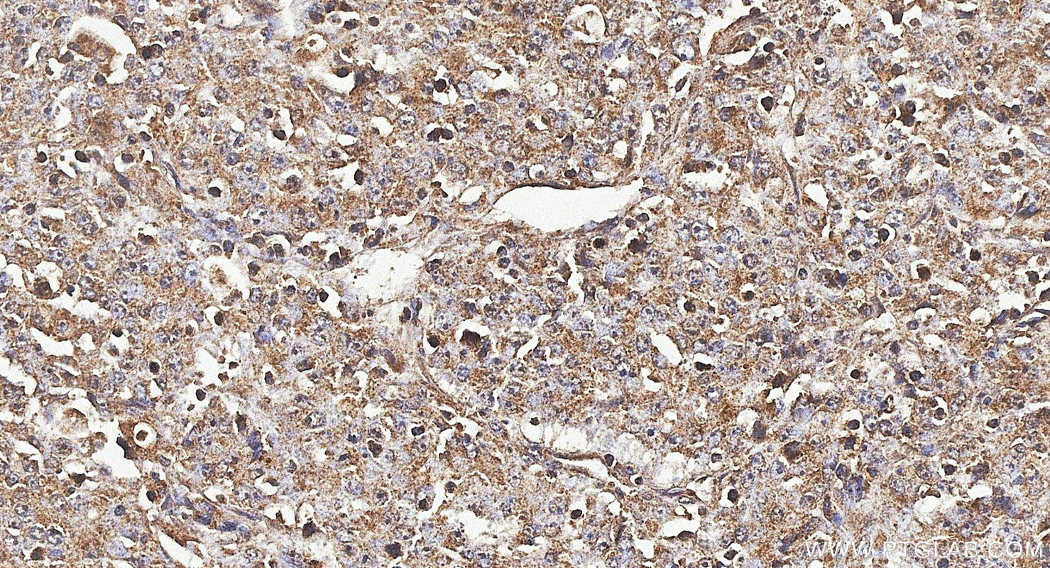 IHC staining of human lymphoma using 22198-1-AP IHC staining of human lymphoma using 22198-1-AP