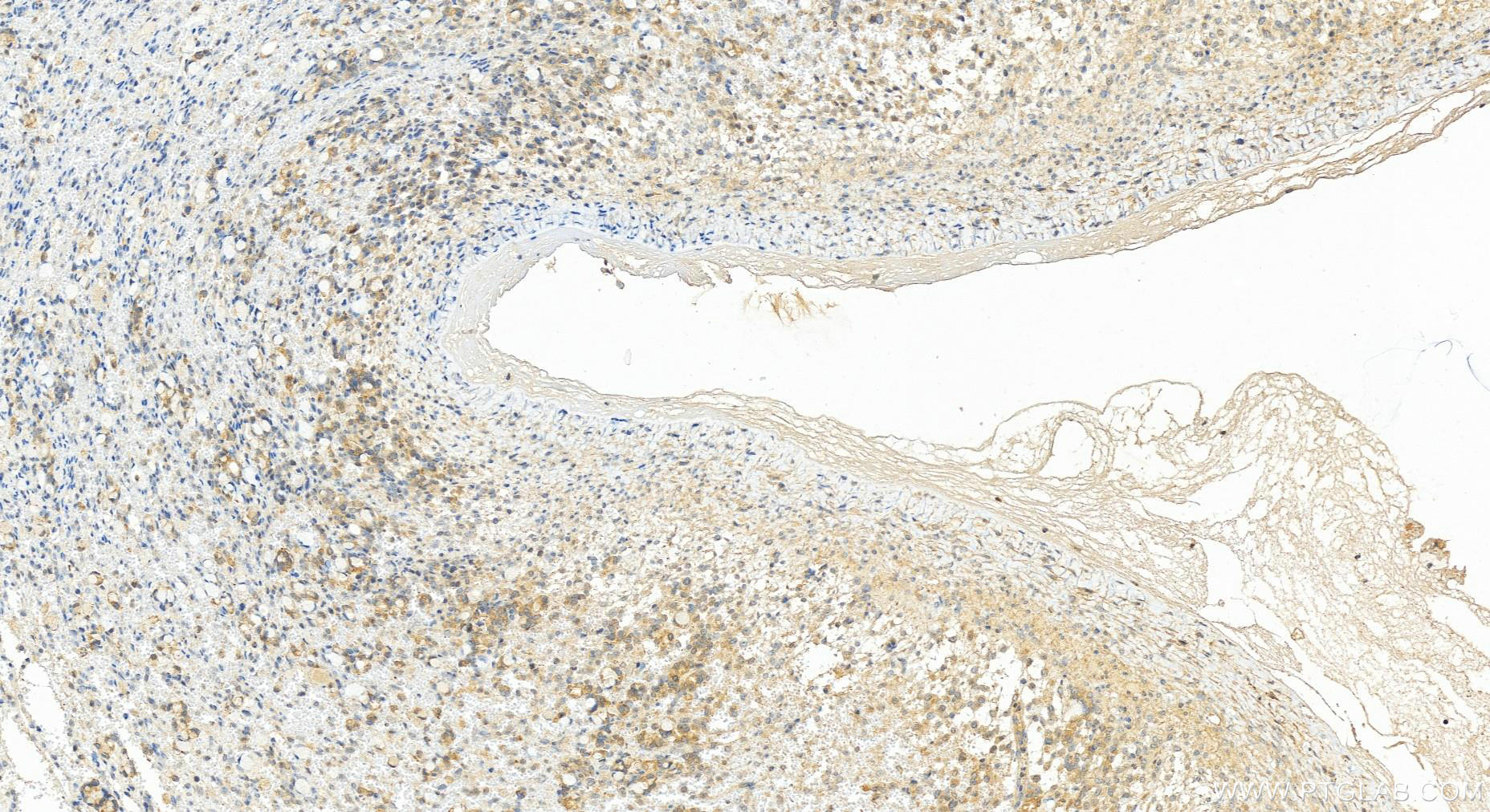 IHC staining of human ovary cancer using 15641-1-AP