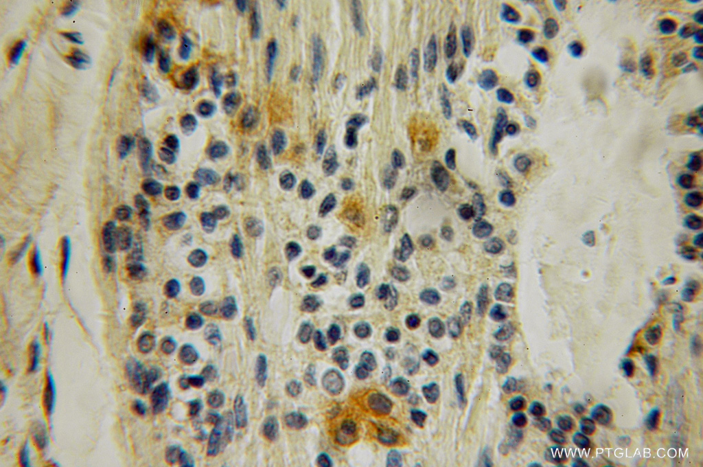 IHC staining of human breast cancer using 12882-1-AP