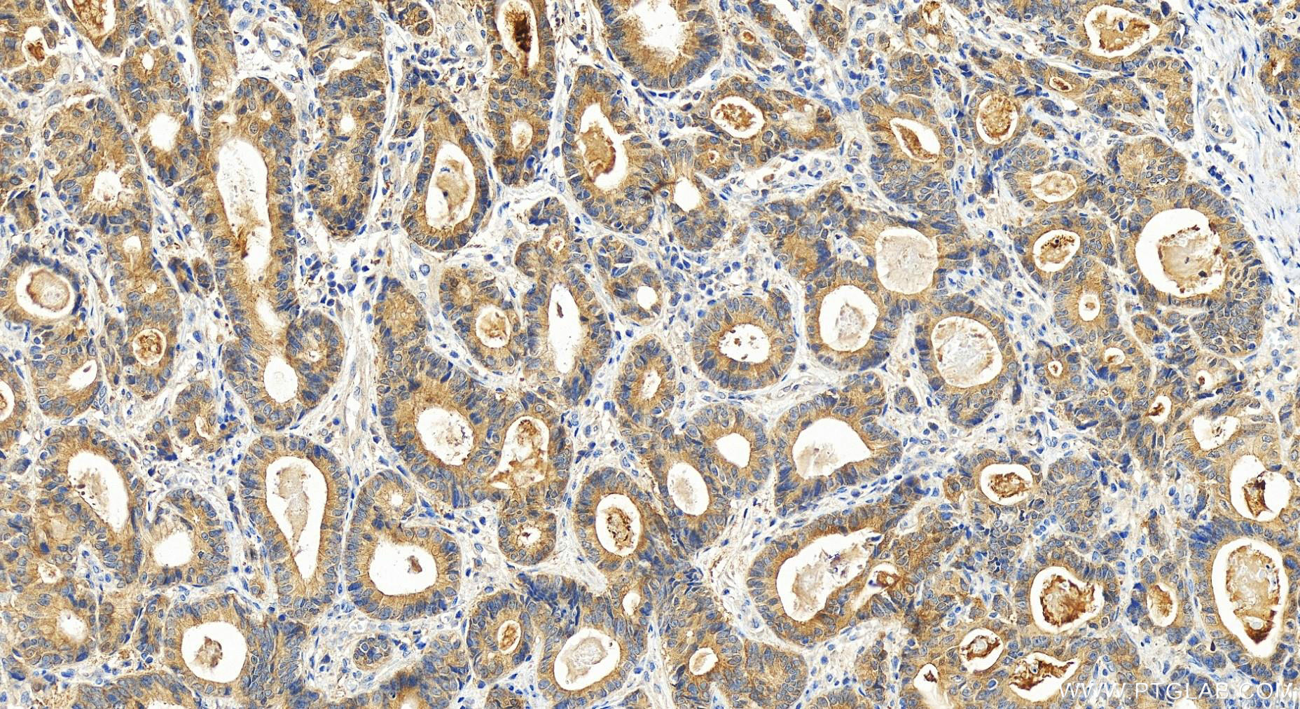 IHC staining of human stomach cancer using 15957-1-AP
