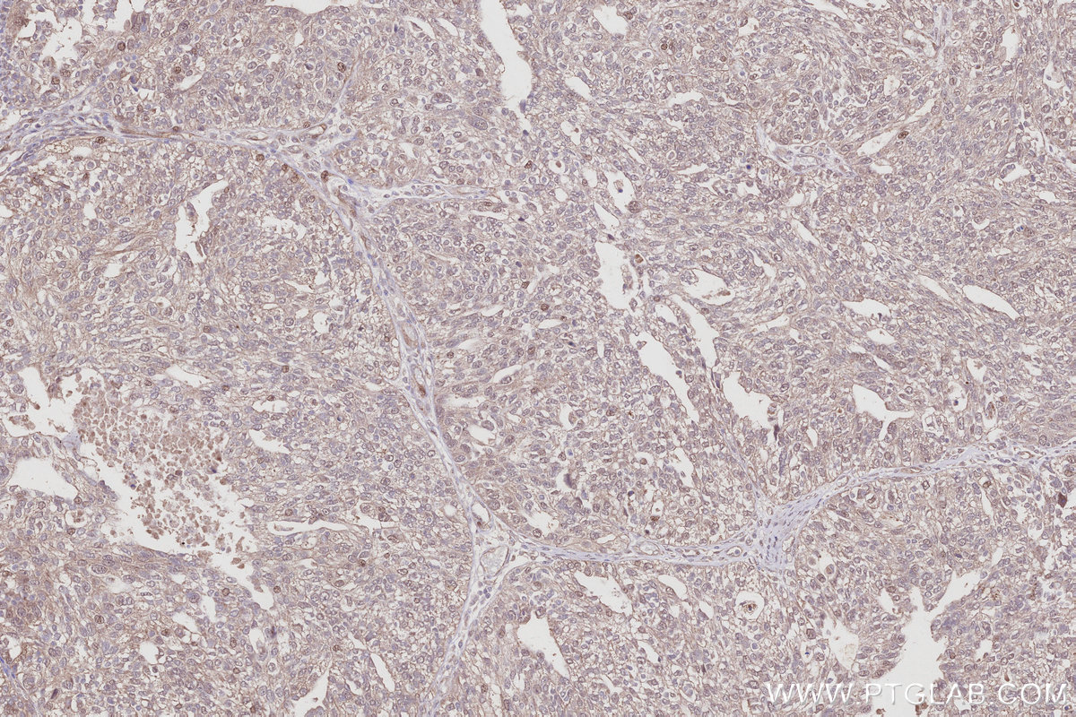 IHC staining of human ovary cancer using 68045-1-Ig IHC staining of human ovary cancer using 68045-1-Ig