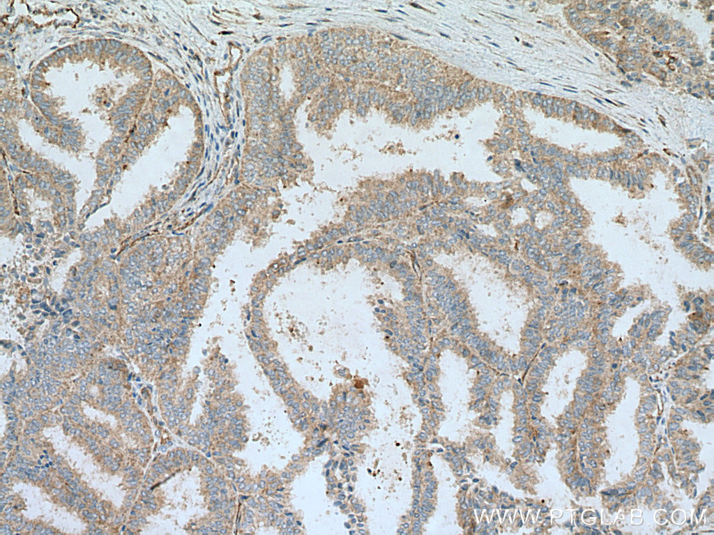 IHC staining of human ovary tumor using 11127-2-AP