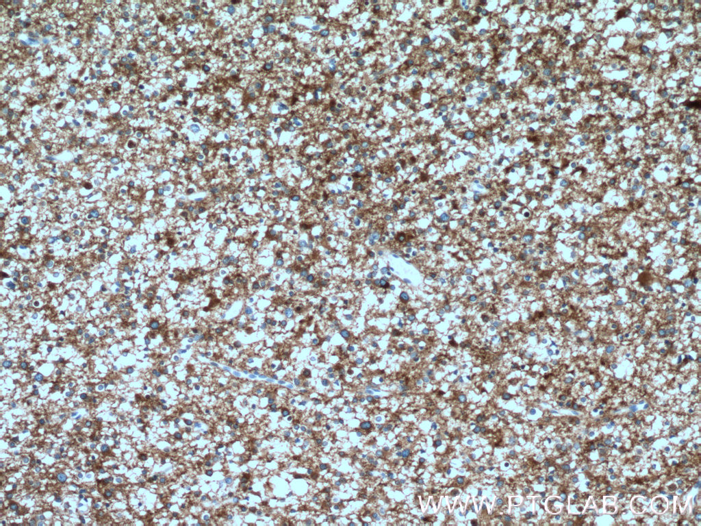 IHC staining of human gliomas using 12435-1-AP