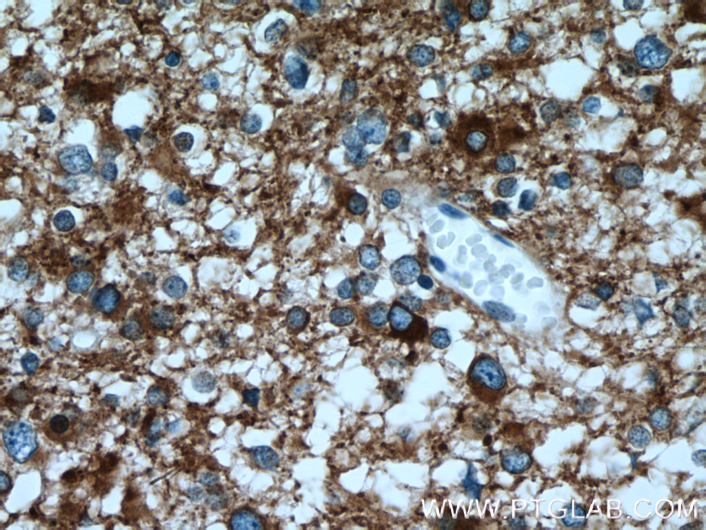 IHC staining of human gliomas using 12435-1-AP